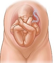 My Baby is Breech, now what?